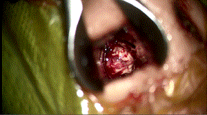 Direct Trans-Nasal Trans-Sphenoid Excision of Pituitary Adenoma